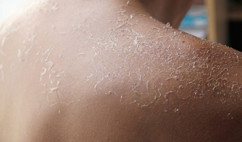 dry peeling skin on back dry peeling skin on back